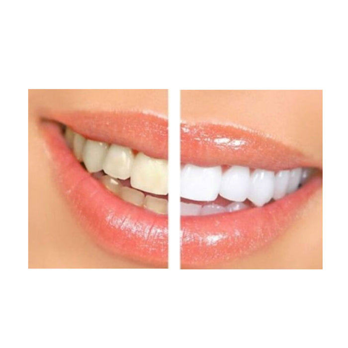 5 Pack Instant Teeth Whitening Pen Professional Strength Cleaning Dental Gel Lot