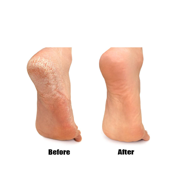 3 PC Pedicure Callous Callus Shaver Foot Care Hard Tough Skin Corn Remover Tool
